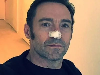 Hugh Jackman după intervenție- Foto: Daily Mail