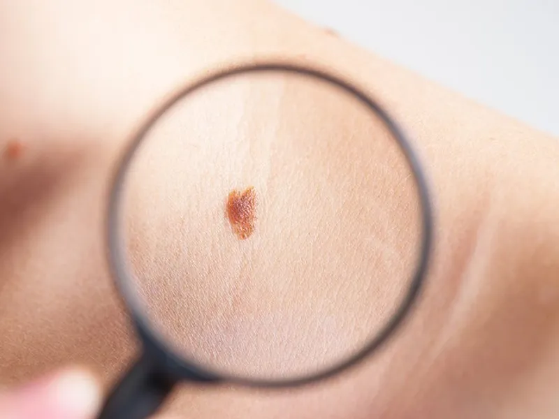 Un medicament pentru tratarea melanomului avansat, aprobat în SUA. / Foto: conehealth.com