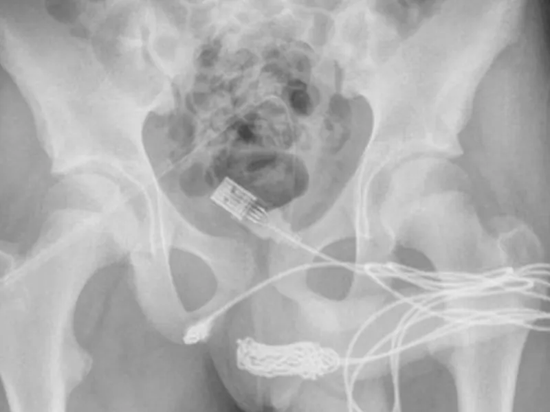 Un tânăr a vrut să-și măsoare "virilitatea" din interiorul corpului cu un cablu USB. A rămas blocat - FOTO: Urology Case Reports