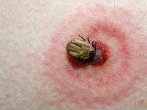 Căpușele transmit boala Lyme/Foto: Shutterstock