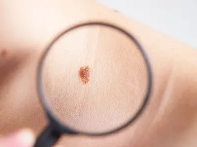 Un medicament pentru tratarea melanomului avansat, aprobat în SUA. / Foto: conehealth.com