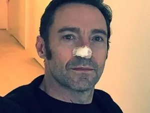 Hugh Jackman după intervenție- Foto: Daily Mail