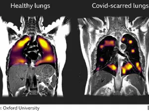 Covid-19 cauzează leziuni pulmonare care pot fi observate la mai multe luni de la îmbolnăvire, arată un studiu Oxford/FOTO: Twitter